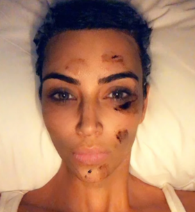 Kim Kardashian, arc, pikkelysömör